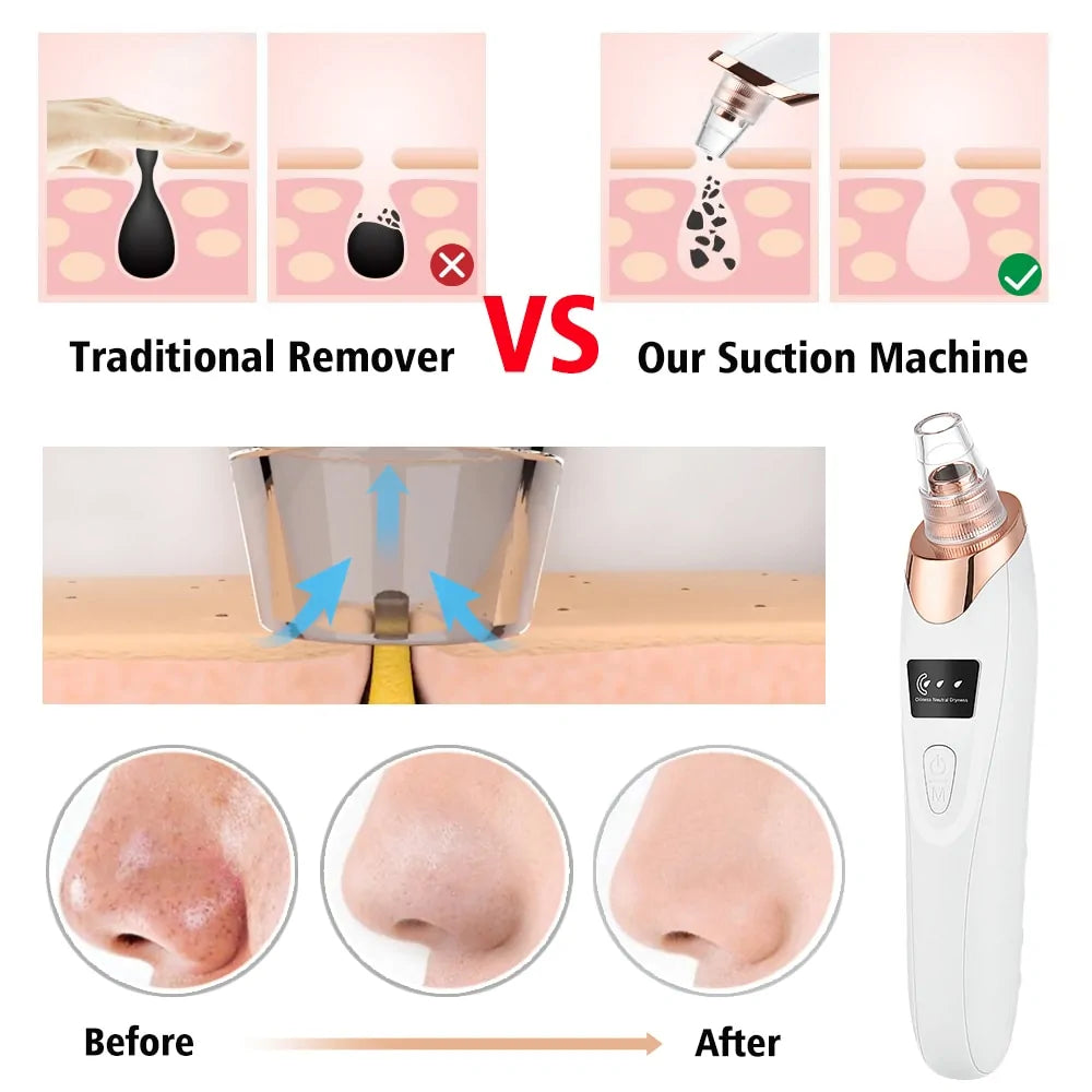 Blackhead Remover Vacuum Acne Pimple Black Spot